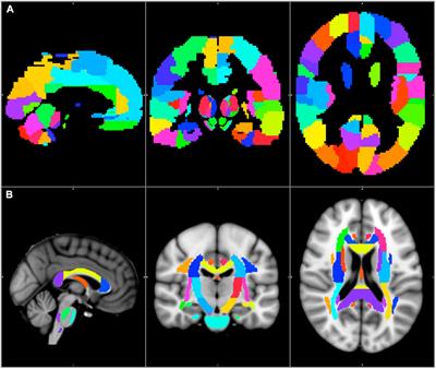 Predicting the true extent of glioblastoma based on probabilistic tractography